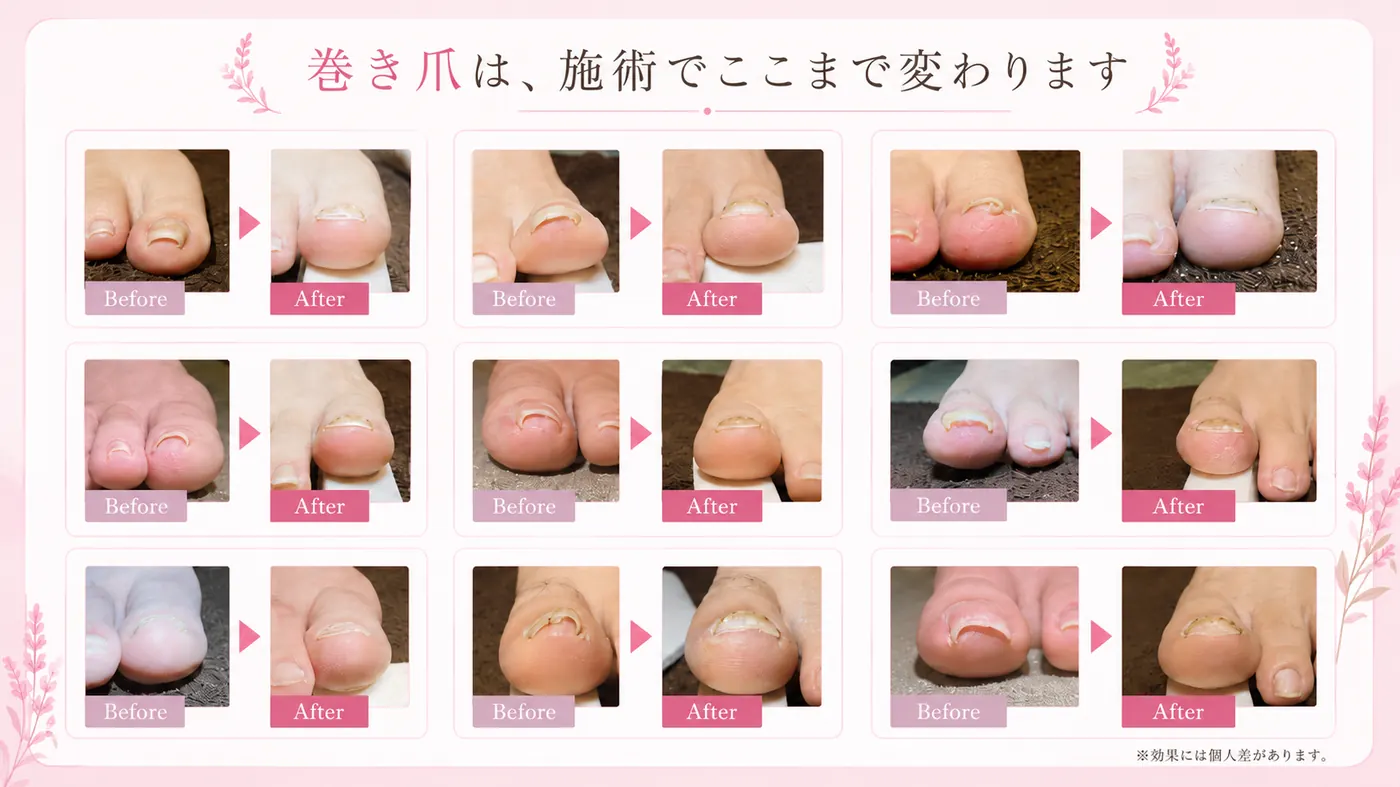 巻き爪は、施術でここまで変わります。9症例のビフォーアフター写真（※効果には個人差があります）