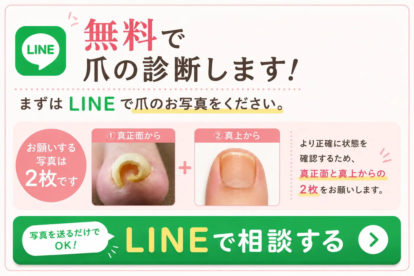 無料で爪の診断します！まずはLINEで爪のお写真をください。真正面と真上からの2枚をお願いします。LINEで相談する（写真を送るだけでOK）