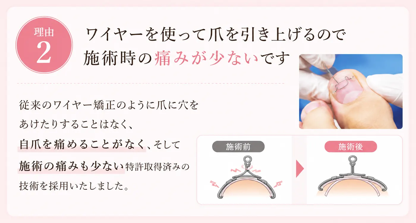 理由2：ワイヤーを使って爪を引き上げるので施術時の痛みが少ないです。従来のワイヤー矯正のように爪に穴をあけることはなく、自爪を痛めることがない特許取得済みの技術を採用しました。