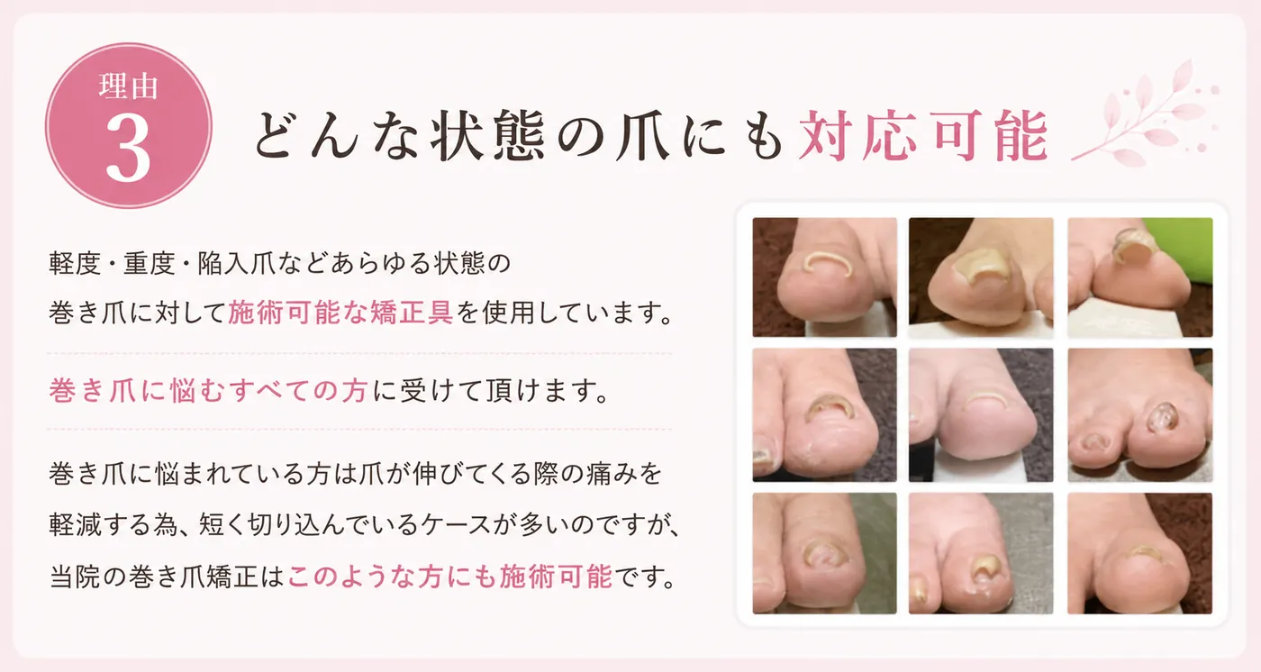 理由3：どんな状態の爪にも対応可能。軽度・重度・陥入爪などあらゆる状態の巻き爪に施術可能な矯正具を使用。巻き爪に悩むすべての方に受けて頂けます。